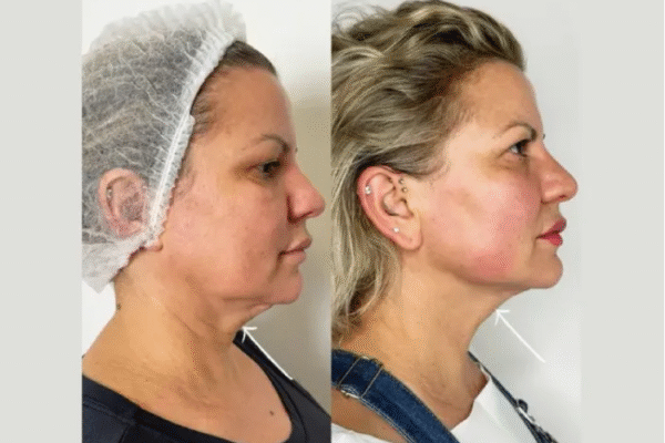 Endolift in Dubai: How It Works and What to Expect