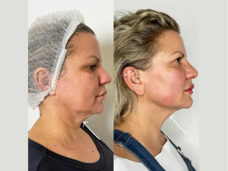 Endolift in Dubai: How It Works and What to Expect