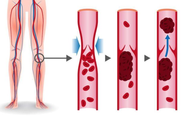 blood clot in leg