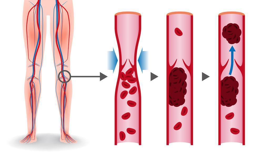 blood clot in leg