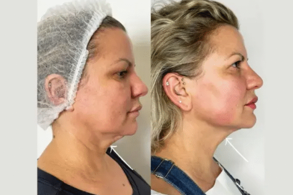 Endolift Treatments in Dubai: Safe, Effective, and Non-Invasive