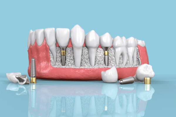 Essential Dental Care Tips and Common Implant Issues Dental care Tips & Implant Problems