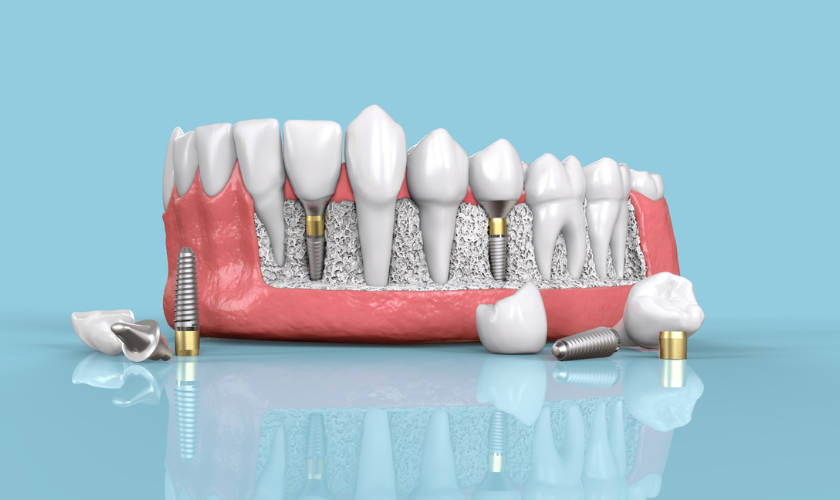 Dental care Tips & Implant Problems